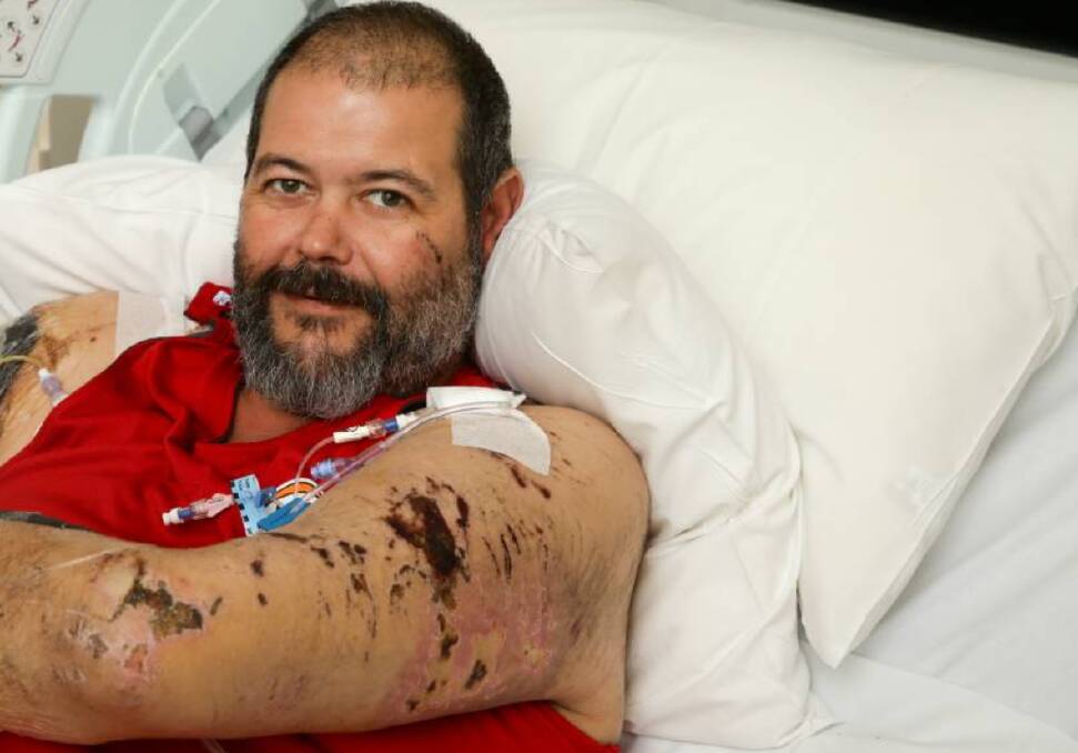 ATTACK VICTIM: Brendan 'Bear' Clark was working on a Coonamble property when he was mauled by two large dogs and had to have his right arm amputated following the attack. Picture: JONATHAN CARROLL